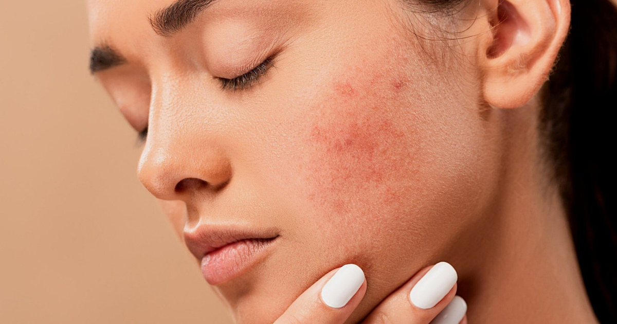 Acne Treatment