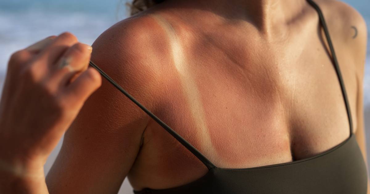 Treating and Preventing Sunburn