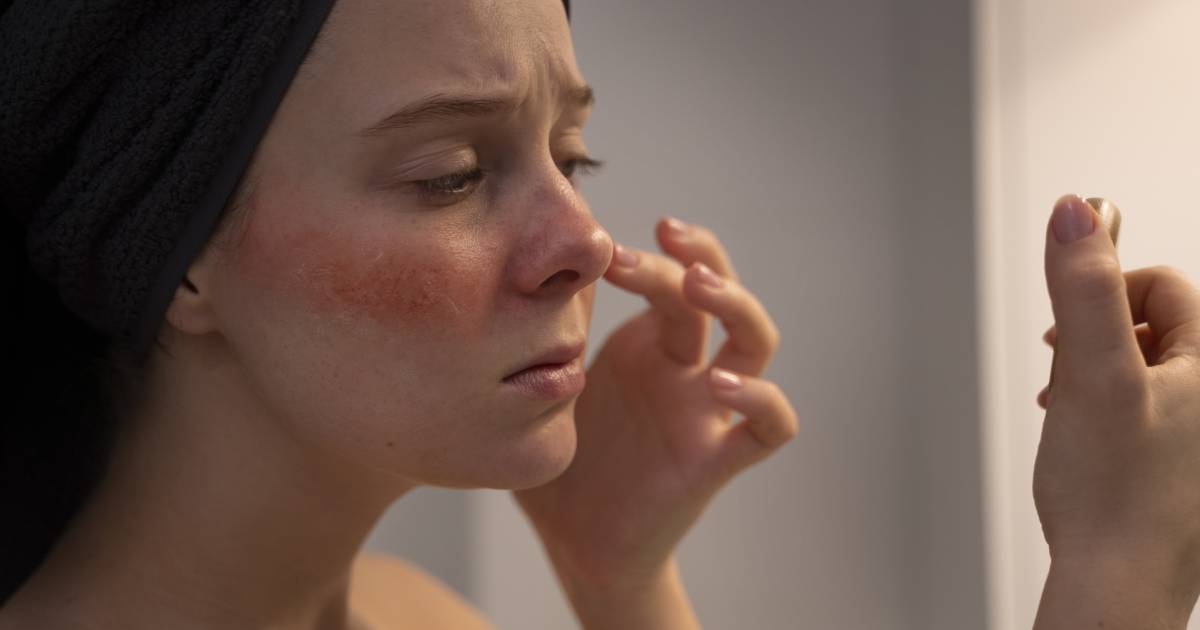 Skincare for Rosacea