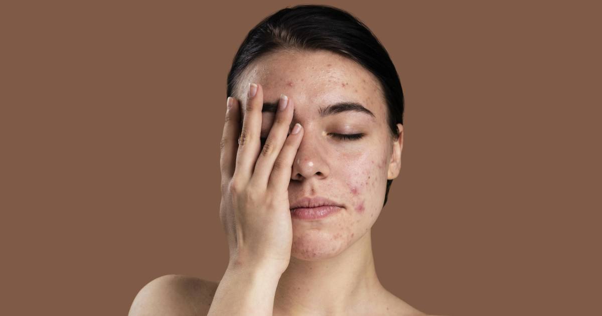 Facts About Hormonal Acne