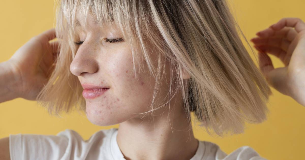Prevent Acne Scars
